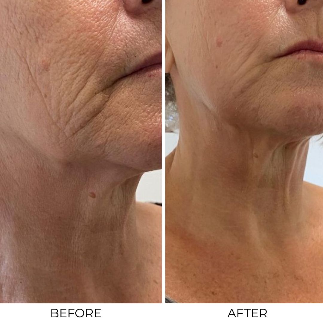 Lifting Peptide Serum